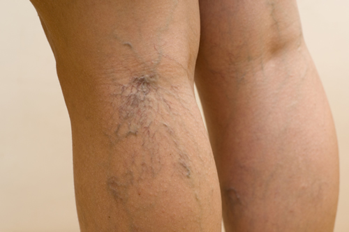 a visszér nagyon fájdalmas láb hirudoterápia visszeres lábak esetén